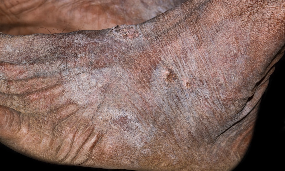 Atopic Dermatitis on feet.