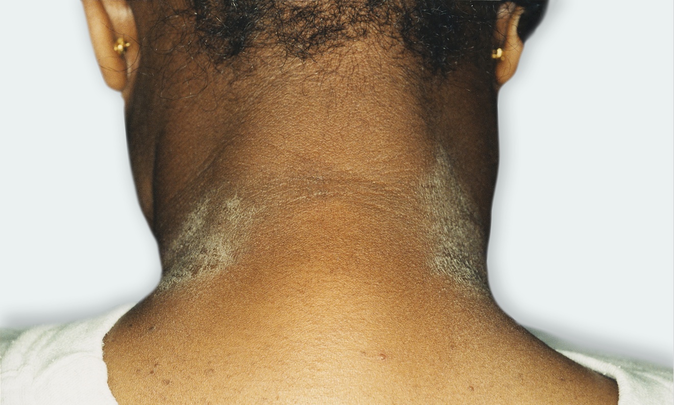 Atopic Dermatitis on neck.