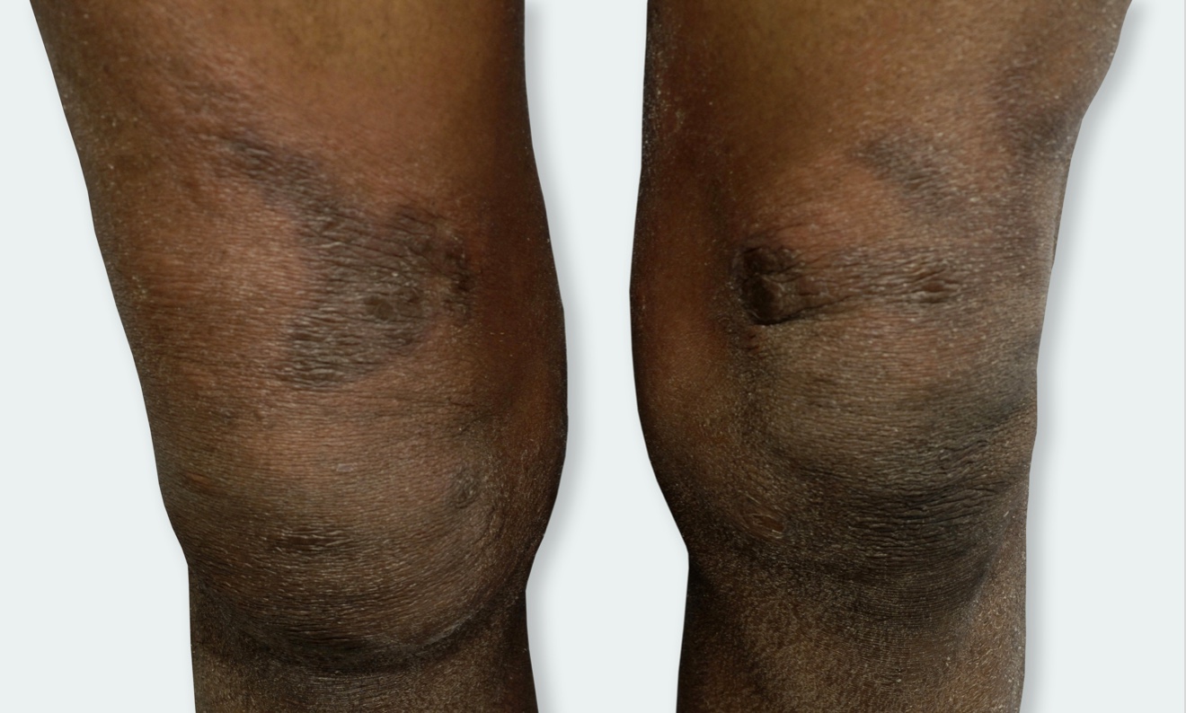 Atopic Dermatitis on legs.