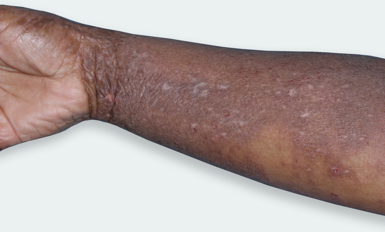 Atopic Dermatitis on arms.